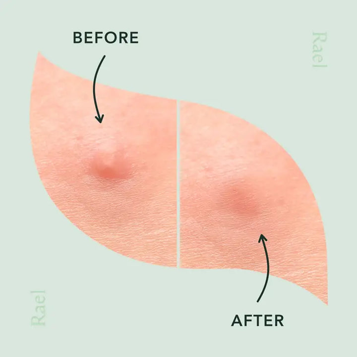 Rael Beauty Miracle Patch Microcrystal Spot Pimple Cover